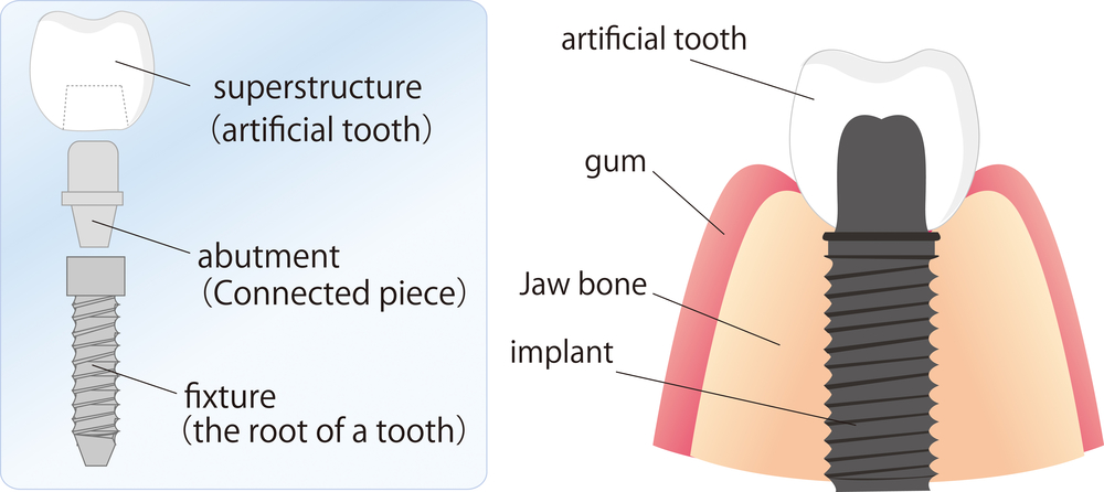Image of the parts of a dental implant.