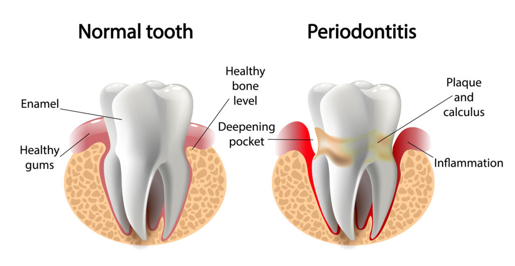 Image of how a tooth infected by gum disease looks compared to a healthy one 