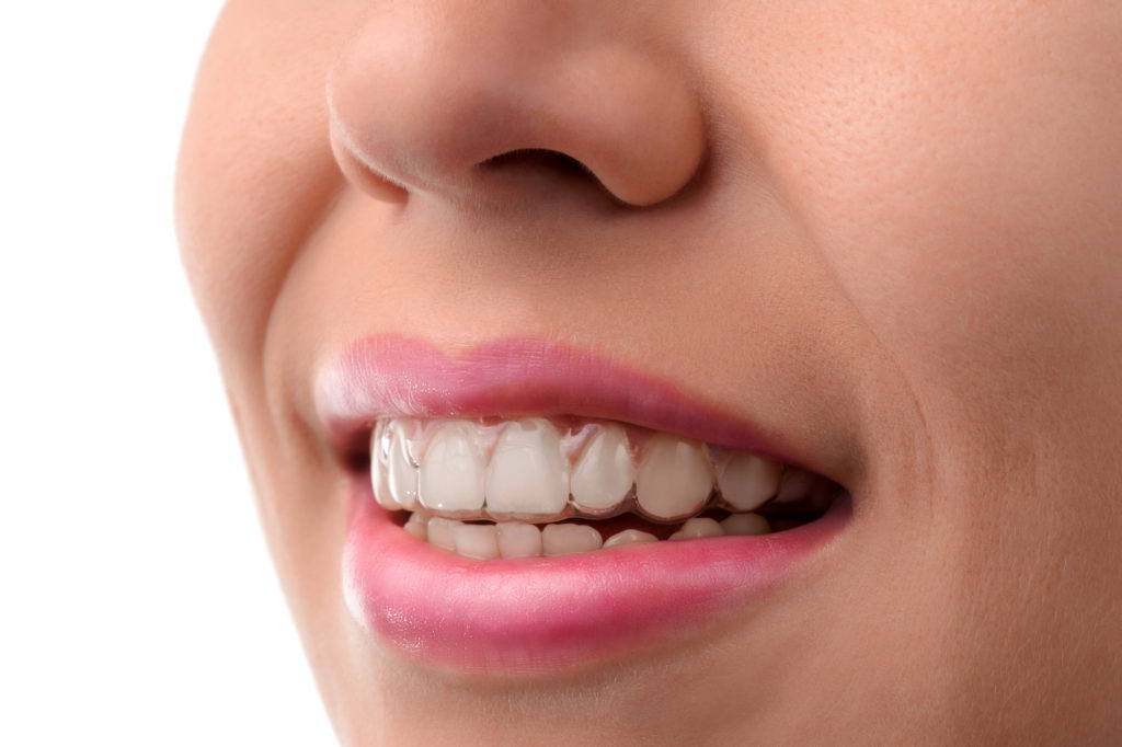 Closeup of woman who is wearing clear braces to correct her bite. 